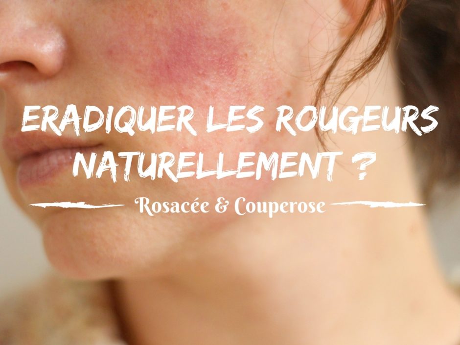 Comment traiter naturellement les rougeurs ? (rosacée Comment traiter naturellement les rougeurs ? (rosacée