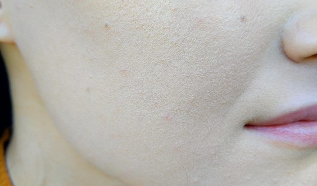 Les 6 Mauvaises Habitudes Qui Ont Aggrave Mes Boutons D Acne
