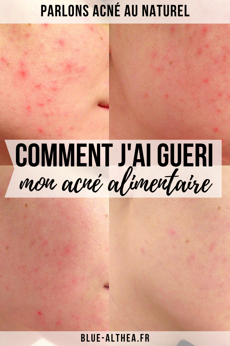 Dans cet article, on parle acné allergique, ou encore acné alimentaire comme j'aime l'appeler. Je t'y raconte mon expérience, mes tests et comment j'ai réussi à m'en débarrasser. #acnefree #acnesolutions #alimentationsaine